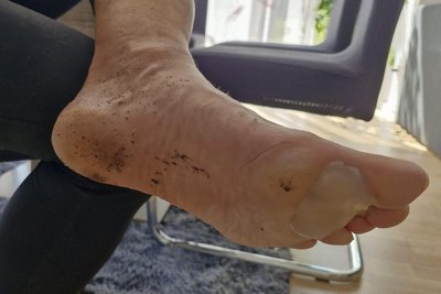 So sehen Füße nach 363 nonstop gelaufenen Kilometern aus.