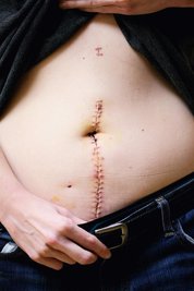 Morbus Crohn kann den kompletten Verdauungstrakt betreffen - von der Speiseröhre bis zum After und alle Schichten der Darmwand. 