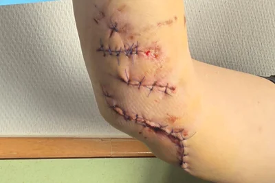 Der Hund hat den rechten Arm der Fraureutherin übel zugerichtet. Es musste mehrfach genäht werden.