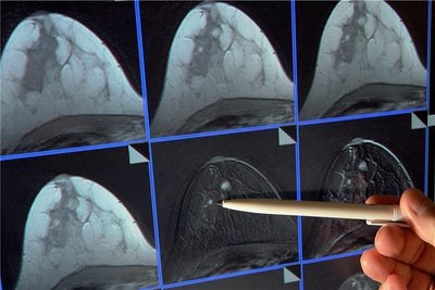 Abklärungsdiagnostik nach positivem Screeningbefund - im MRT ist ein kleiner Tumor in der Brust zu sehen. 
