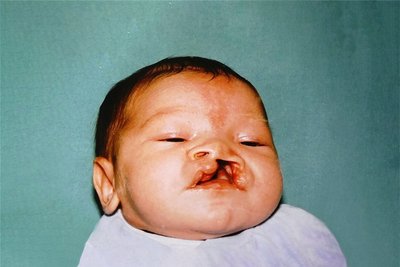 Kurz nach der Geburt. Die Lippen-Kiefer-Gaumen-Spalte erschwert das Trinken.