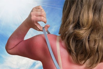 Autsch. Hier ist der Sonnenschutz eindeutig zu kurz gekommen. 