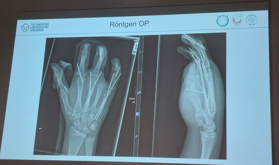 Das Röntgenbild zeigt, wie die Knochen in Felix' Hand fixiert wurden.