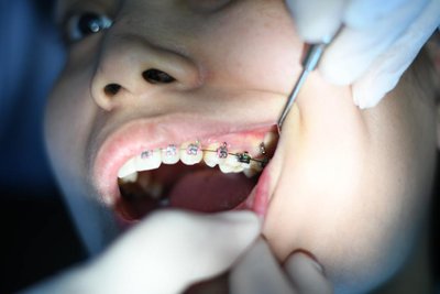 Kein Makel mehr: Fast jedes zweite Kind in Deutschland bekommt eine Zahnspange, meist eine festsitzende mit Brackets aus Metall, Keramik oder Kunststoff. 