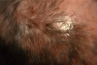 So sieht der Hautpilz Trichophyton tonsurans aus, wenn er auf einer Kopfhaut ausgebrochen ist.