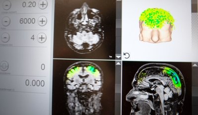 Auf einem Bildschirm kann die Ärztin den Einsatz der Stimulationsimpulse in einzelnen Hirnregionen auf Basis eines MRT-Bildes verfolgen. 