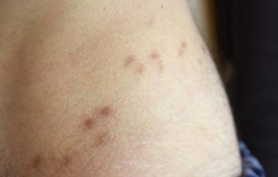 Narben im Hüftbereich nach einer überstandenen Skabies-Infektion.