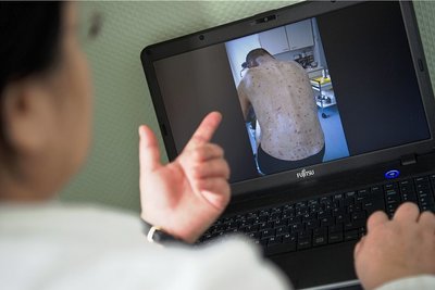 Unbehandelt breitet sich die Krätze auf den ganzen Körper aus, wie eine Ärztin hier an einem Patienten zeigt. 