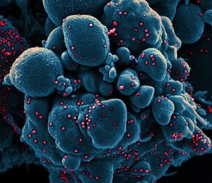 Ein vom "National Institute of Allergy and Infectious Diseases" aufgenommenes Bild zeigt einer Zelle (blau), die mit dem Coronavirus (rot) infiziert ist.