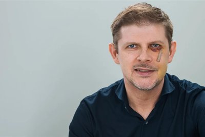 Die Spuren des Angriffs waren Matthias Ecke danach deutlich anzusehen.