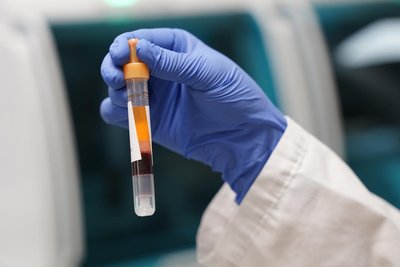 Eine umfangreiche Untersuchung der Erbanlagen (Symbolbild) führte nach Monaten zur entscheidenden Erkenntnis am Klinikum Chemnitz: Sarah Ahmed (Name geändert) leidet an einer extrem seltenen angeborenen Krankheit.