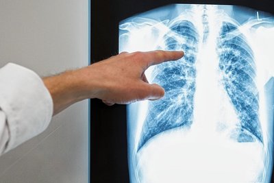 In Chemnitz sind erneut Tuberkulosefälle aufgetreten. Auch das Gesundheitsamt in Annaberg untersucht mögliche Betroffene.