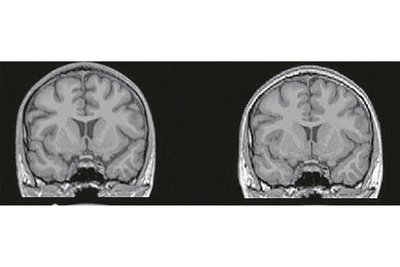 Magersucht lässt Gehirn schrumpfen: Der linke Scan zeigt das Gehirn einer Patientin des Uniklinikums Dresden vor der Therapie, der rechte zeigt es danach.