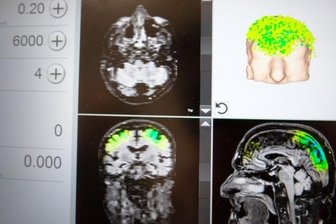 Alzheimer: Stoßwellen wecken Nervenzellen auf - Auf einem Bildschirm kann die Ärztin den Einsatz der Stimulationsimpulse in einzelnen Hirnregionen auf Basis eines MRT-Bildes verfolgen.