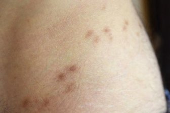 Anzahl der Krätze-Fälle weiter gestiegen - Narben im Hüftbereich nach einer überstandenen Skabies-Infektion.