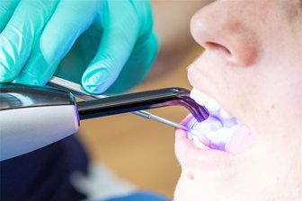 Aus für Amalgam: Ab Januar dürfen es Zahnärzte nicht mehr verwenden - Was kommt rein?