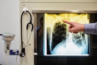 Chemnitz meldet seit Jahrzehnten wieder Diphtherie-Fälle - In Chemnitz gibt es derzeit Fälle von Diphtherie und Tuberkulose. Tuberkulose-Bakterien können durch Tröpfcheninfektion beim Husten, Niesen, Sprechen und Lachen weitergegeben werden.