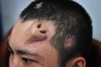 Chinesische Ärzte züchten Nase auf Stirn eines Mannes -