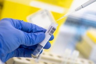 Coronavirus - die aktuelle Entwicklung - Ein Wissenschaftler nimmt in einem Diagnostiklabor mit einer Pipette abgetrenntes Plasma einer Blutprobe.