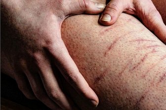 Die Jugend nach Corona: Anna (17) erzählt, warum sie sich ritzt - Anna ritzt sich. Und sie sagt: "Corona hat mich dazu gebracht, andauernd über den Sinn des Lebens nachzudenken."