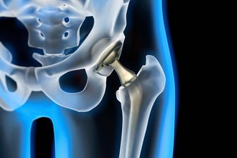 Gesundheitsakademie am Erzgebirgsklinikum in Stollberg widmet sich Hüft- und Kniegelenken - Das Erzgebirgsklinikum lädt zur nächsten Gesundheitsakademie.