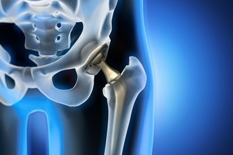 Gesundheitsakademie im Erzgebirge: Wann ein neues Gelenk nötig ist - Um den Ersatz von Hüft- und Kniegelenken geht es in der nächsten Gesundheitsakademie.