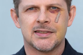 Gewalt in Sachsen: Mehr als dreimal so viele Straftaten von rechts wie von links - Der Europa-Abgeordnete Matthias Ecke (SPD) war eines der prominenten Opfer rechter Gewalt im Vorjahr. Beim Plakatieren für die Europawahl wurde er in Dresden angegriffen. Die aus dem Umfeld der „Elblandrevolte“ stammenden Verdächtigen zertrümmerten ihm Jochbein und Augenhöhle.