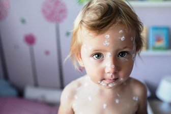 Gürtelrose oft in der Kindheit begründet - Zinkpaste lindert den Juckreiz der Windpockenbläschen. Doch nach dem Abheilen ist oft nicht alles ausgestanden.