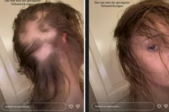 Haarausfall, „Mädchen-Wohnung“, neuer Mann an ihrer Seite: Dresdner Influencerin Patrice Aminati antwortet den Fans - In ihrer Instagram-Story zeiget Patrice Aminati kahle Stellen auf ihrem Kopf als Folge der Krebsbehandlung. (Montage)
