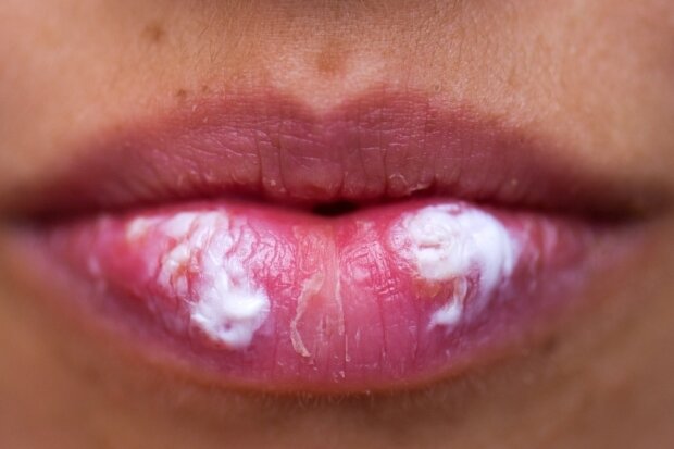 Herpes bleibt für immer - Cremen gegen hässliche Bläschen.