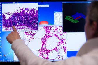 Jedes Jahr über 32.000 neue Krebskranke in Sachsen - Ein entferntes Stück Gewebe aus dem Dickdarm wird untersucht. Auch solche histologischen Befunde fließen in das Krebsregister ein.