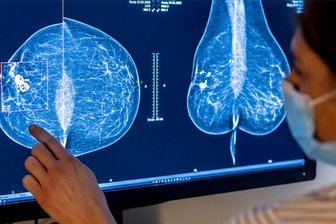 „Mamma mia“: Klinikum Mittweida informiert zum Thema Brustkrebs - Medizinisches Personal untersucht mit einer Mammografie die Brust einer Frau auf Brustkrebs.