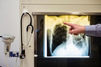 Nach Tuberkulose-Ausbruch in Chemnitz: Neue Hotline in Sachsen - In Chemnitz sind vier Fälle von Lungentuberkulose bestätigt. Weil die Unsicherheit wächst, schaltet die Barmer ein Hilfsangebot.