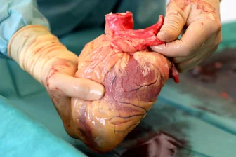 Organspende: Wenn Angehörige nicht wissen, was der Verstorbene gedacht hätte, lehnen sie ab - Ein Transplantationsmediziner hält das Herz eines Verstorbenen in den Händen, das kurz zuvor entnommen wurde.