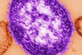 Quarantäne: Masern-Fälle auf dem Luisenhof - Teile eines Masernvirus.