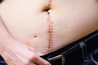 Schicksal Morbus Crohn - eine Patientin erzählt - Morbus Crohn kann den kompletten Verdauungstrakt betreffen - von der Speiseröhre bis zum After und alle Schichten der Darmwand. 