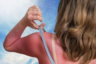 Sonnenbrand: Diese Cremes und Medikamente helfen dagegen - Autsch. Hier ist der Sonnenschutz eindeutig zu kurz gekommen.