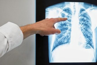 Tuberkulose-Ausbruch in Chemnitz: Pflegeschülerin hatte vor Diagnose monatelang Husten - Rund 150 Kontaktpersonen wurden bisher ermittelt. Bei 25 wurde eine Infektion nachgewiesen.