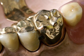 Was geschieht mit dem Zahngold aus dem Plauener Krematorium? - Eine Zahnprothese, die zum Teil aus Gold besteht, steckt in einem Modell eines Unterkiefers bei einem Zahntechniker.