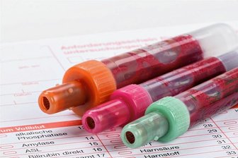 Wie hoch darf der Cholesterinspiegel sein? - Bei der Kontrolle der Blutfettwerte wird auf den Anteil von Gesamtcholesterin, LDL-Cholesterin und Triglyzeriden im Blut geachtet. 