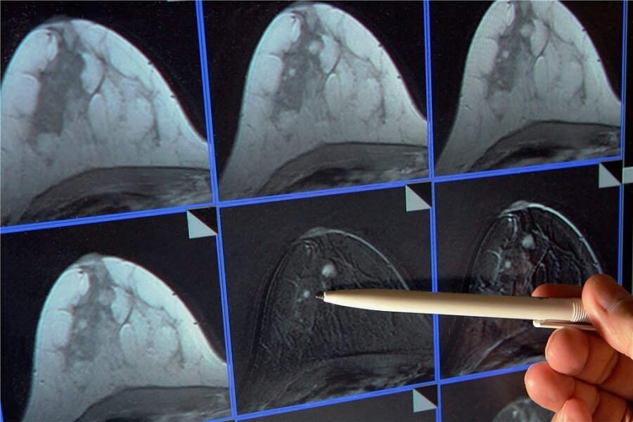 Wie sinnvoll ist die Mammografie? - Abklärungsdiagnostik nach positivem Screeningbefund - im MRT ist ein kleiner Tumor in der Brust zu sehen. 