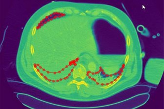 Zwickau: Künstliche Intelligenz hilft bei sekundenschneller Lungendiagnostik - Segmentierung eine Lunge mittels Künstlicher Intelligenz.